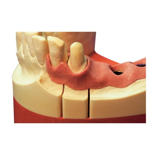 Picodent Majesthetik-Gingimplant - 2 X 50 ml + 12 canules